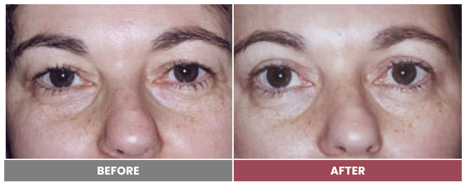 Upper Blepharoplasty - Case 74